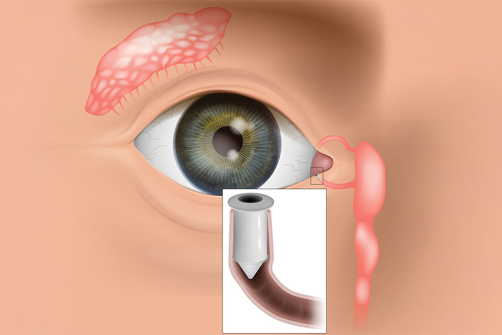 LACRIFILL® (Punctal Plugs) 